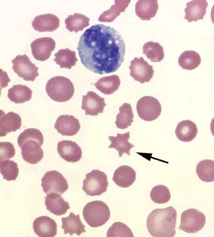 Red Blood Cell Morphology Chart