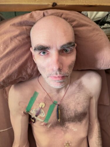 The image shows Whitney laying in a bed on a brown pillow, looking directly at the camera. On the right side of his chest, he has a medical tube attached with green tape.
